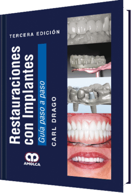 RESTAURACIONES CON IMPLANTES. GUIA PASO A PASO