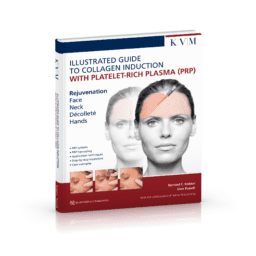 Illustrated Guided to Collagen Induction with Platelet-Rich Plasma (PRP)