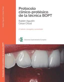 Protocolo clínico-protésico de la técnica BOPT 2º Edic.