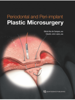 PERIODONTAL AND PERI‑IMPLANT PLASTIC MICROSURGERY MINIMALLY INVASIVE TECHNIQUES WITH MAXIMUM PRECISION