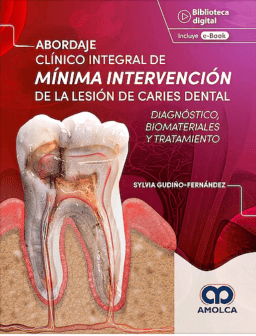 Abordaje Clínico Integral de Mínima Intervención de la Lesión de Caries Dental. Diagnóstico, Biomateriales y Tratamiento