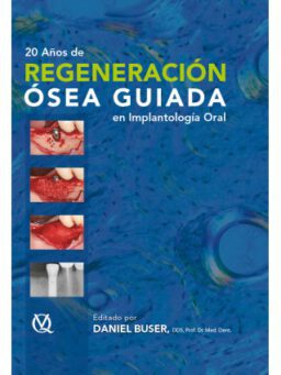 REGENERACIÓN ÓSEA GUIADA
