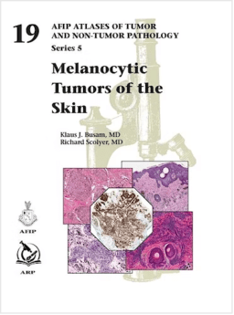 melanocytic tumors skin