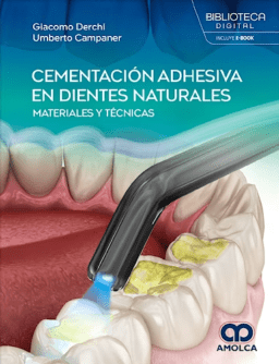 Cementación Adhesiva en Dientes Naturales