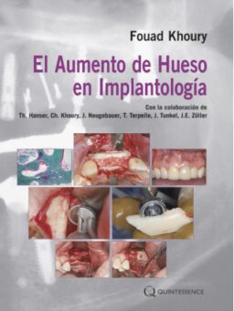 El Aumento de Hueso en Implantología