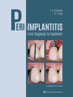 PERI IMPLANTITIS
