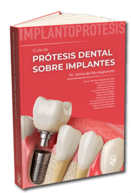 prótesis dental sobre implantes