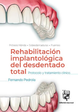REHABILITACIÓN IMPLANTOLÓGICA DEL DESDENTADO TOTAL: Protocolo y tratamiento clínico