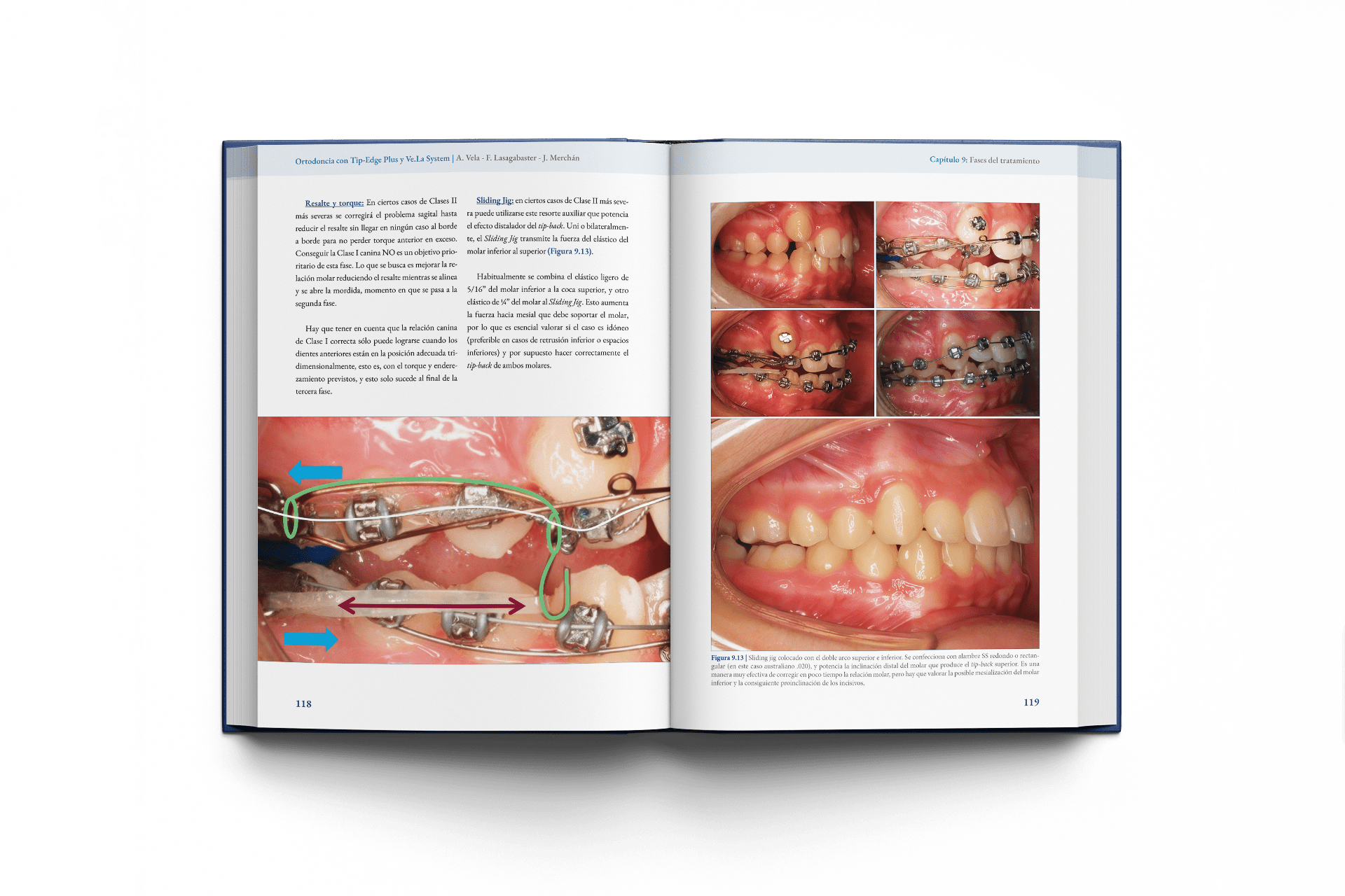 Ortodoncia con Tip-Edge Plus y Ve.La System - Imagen 4