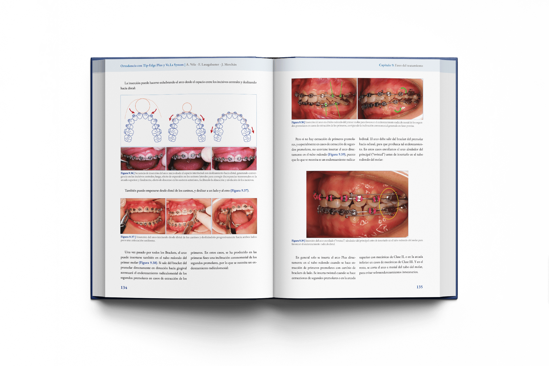 Ortodoncia con Tip-Edge Plus y Ve.La System - Imagen 3